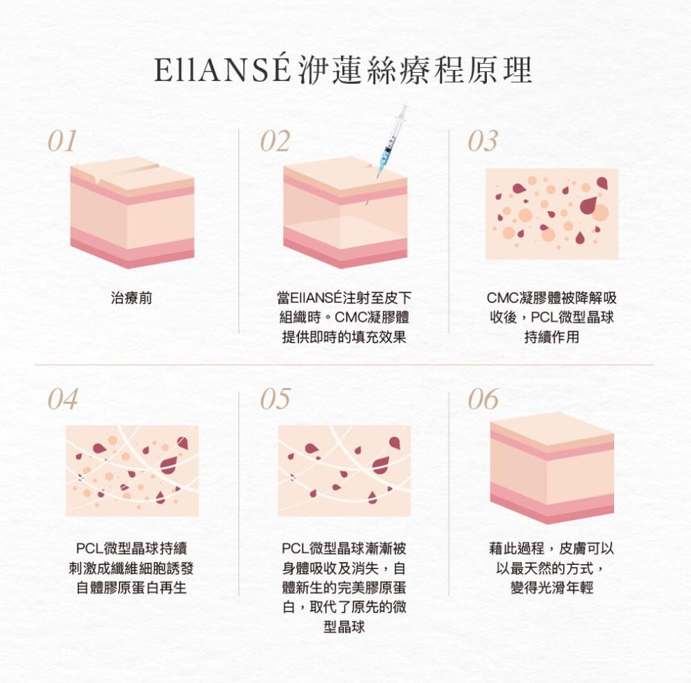 洢蓮絲的療程原理