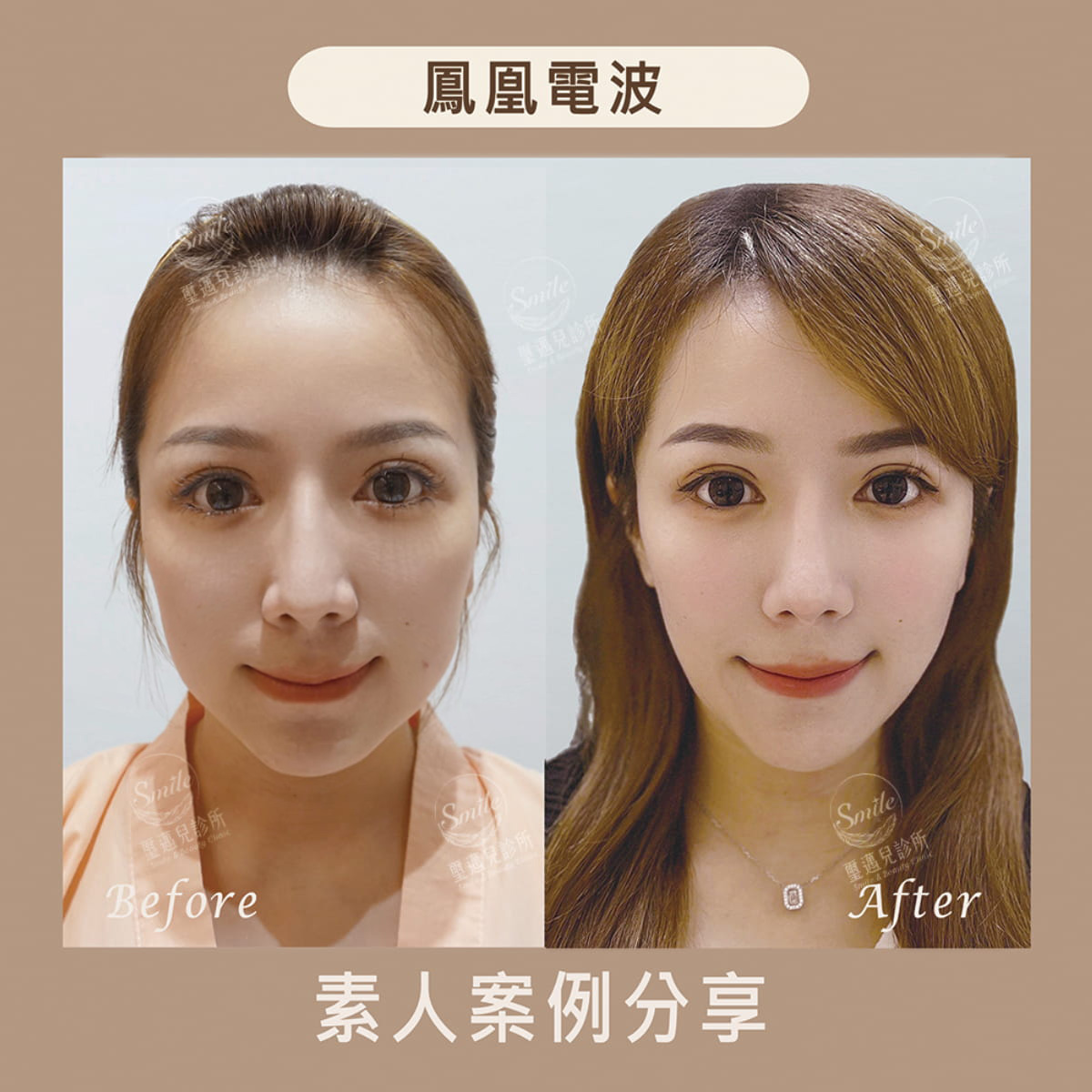 鳳凰電波療程前後比較