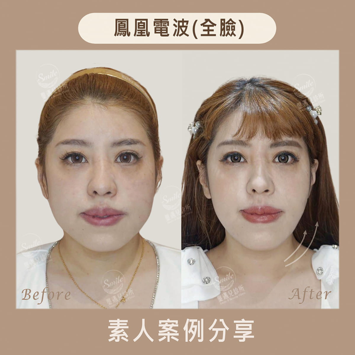 鳳凰電波療程前後比較